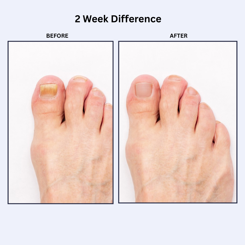 Foot Fungus Relief Pen