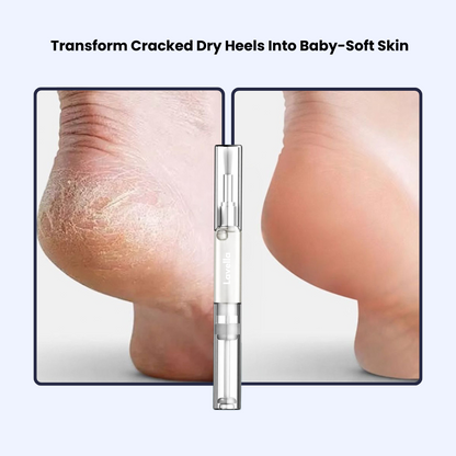 Foot Fungus Relief Pen